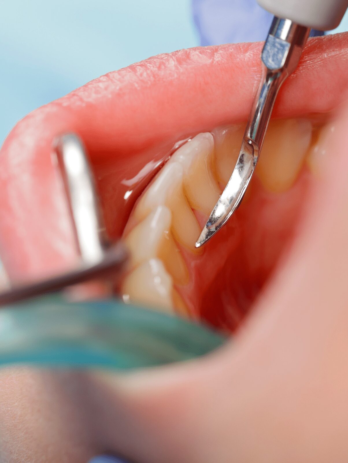 Limpieza dental con ultrasonidos