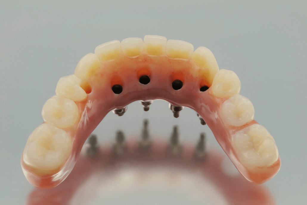 Prótesis sobre Implantes
