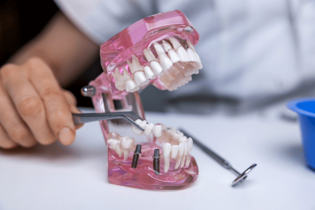 Puente Sobre Implantes